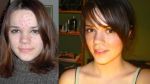 Emily's Amazing Acutane Adventure! (left is from 2005, right is current)